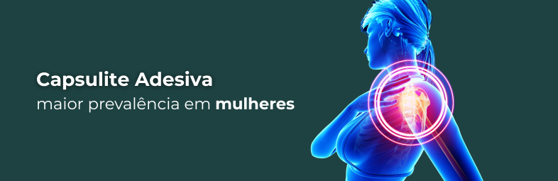 Ilustração médica da capsulite adesiva do ombro (ombro congelado)
